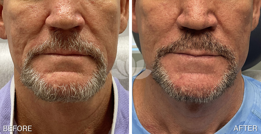 Male patient treated with fillers in South Miami, FL.
